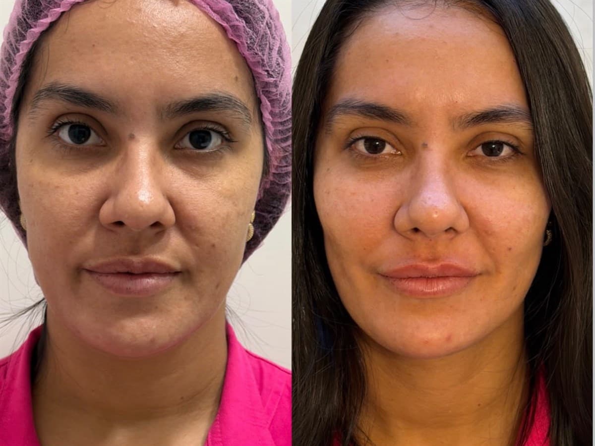 Harmonização Facial