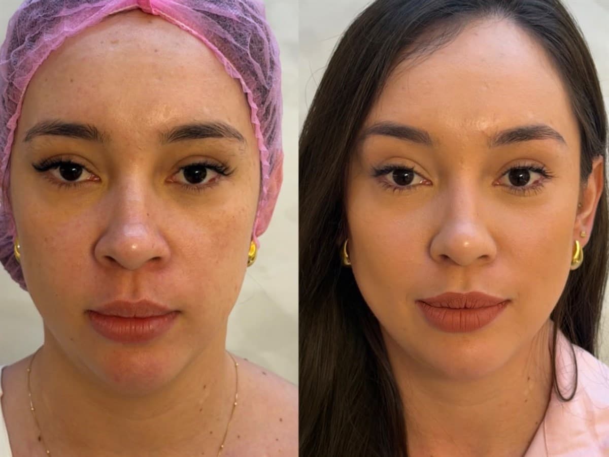 Harmonização Facial