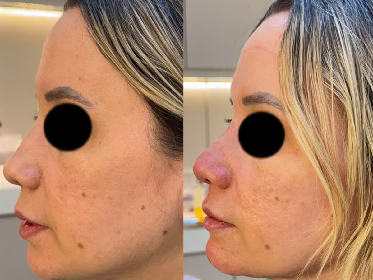Harmonização Facial