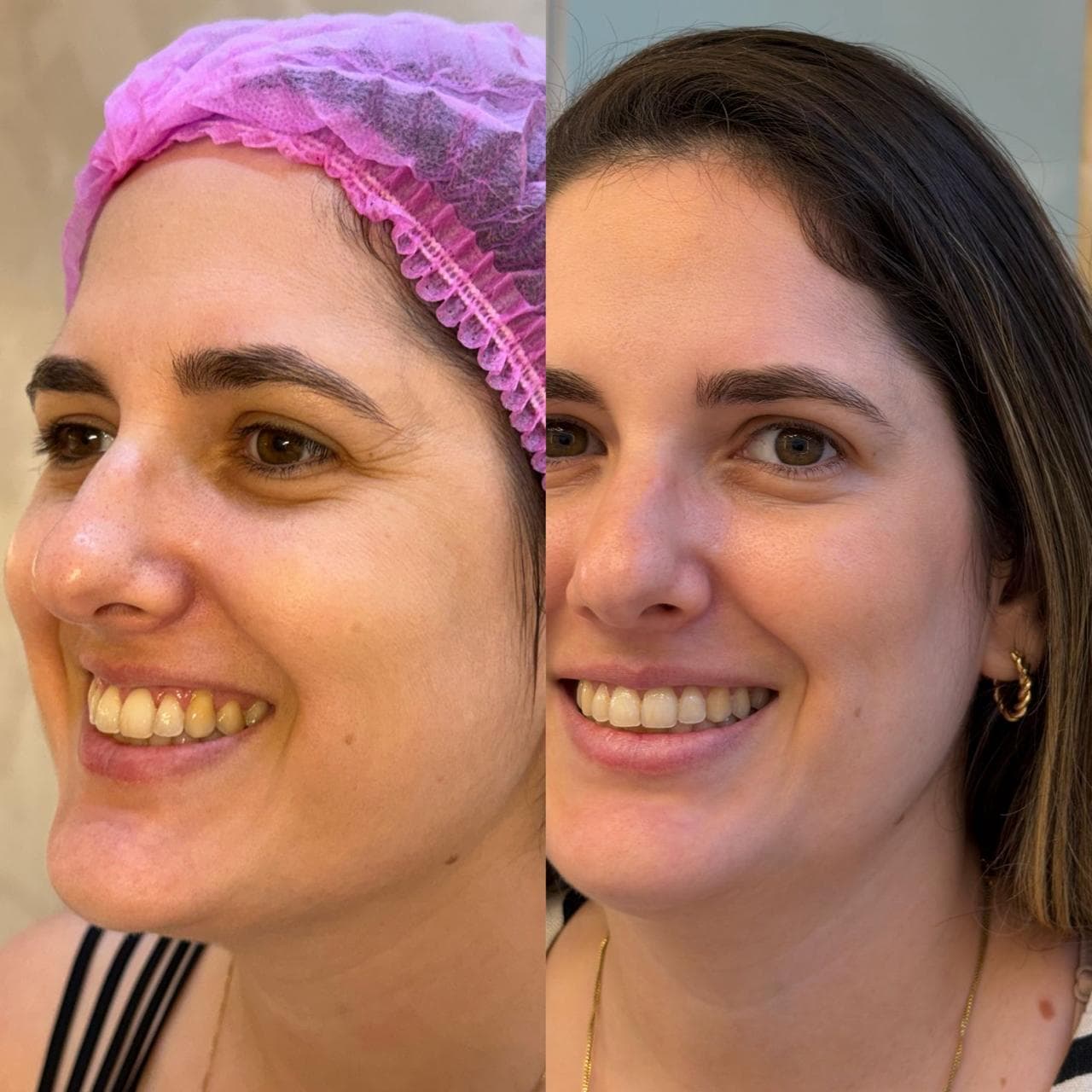Harmonização Facial